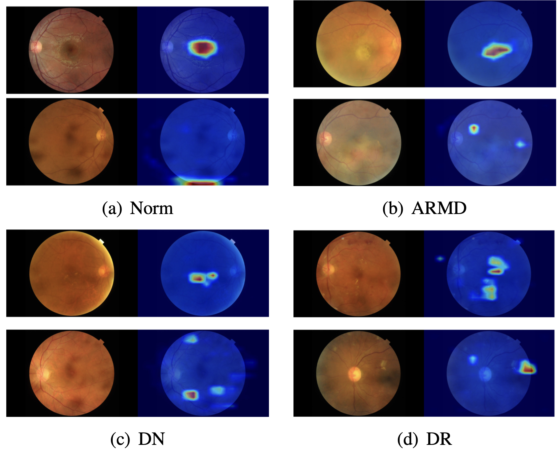 Retinal Disease Classifier